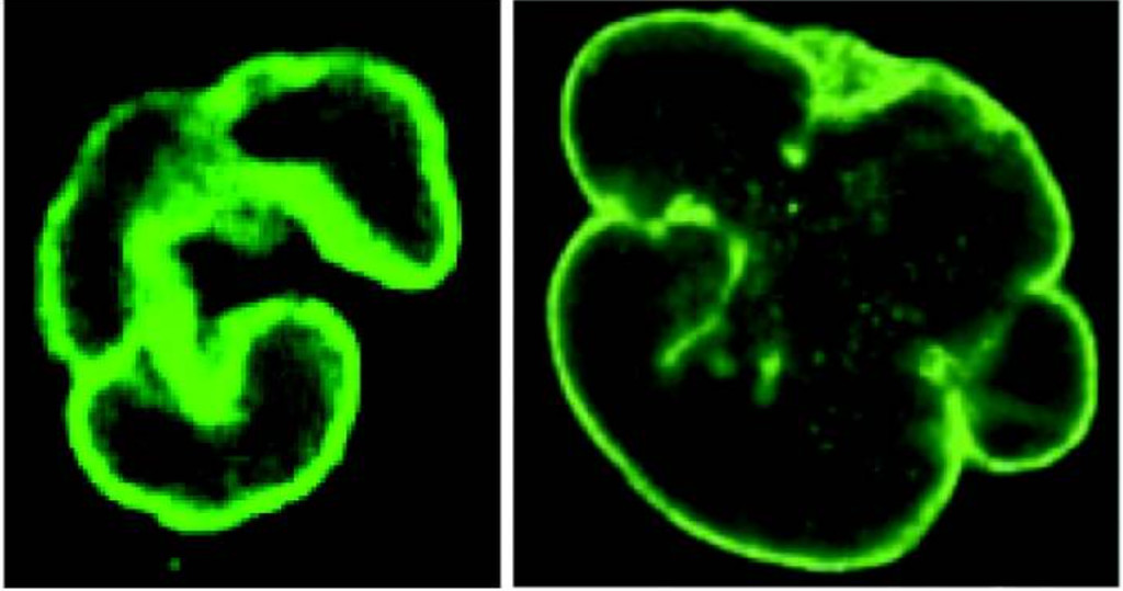 What does the nucleus look like? The mockup depicts a multi-lobed neutrophil nucleus next to the distorted neutrophil nucleus seen in people with the premature aging syndrome.