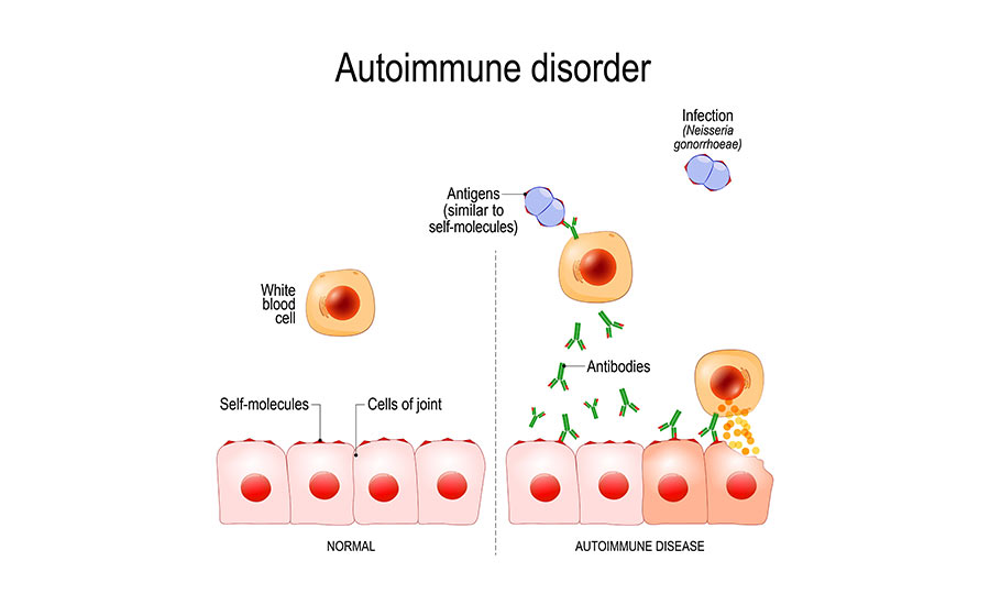 Illustration showing how autoimmune disorders develop.​