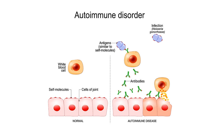 Illustration showing how autoimmune disorders develop.